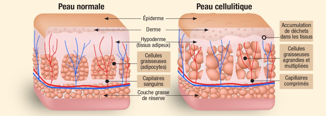 Peau normale vs cellulitique